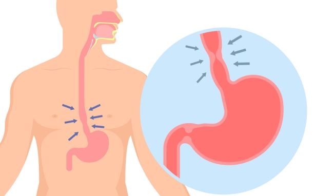 Esophageal Dilation and Stenting